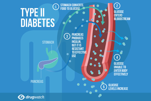 Diabetes Type 2